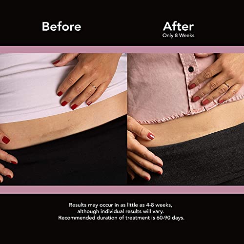 ScarAway C-Section Scar Treatment Strips, Silicone Adhesive Soft Fabric (7 X 1.5 Inch) by ScarAway
