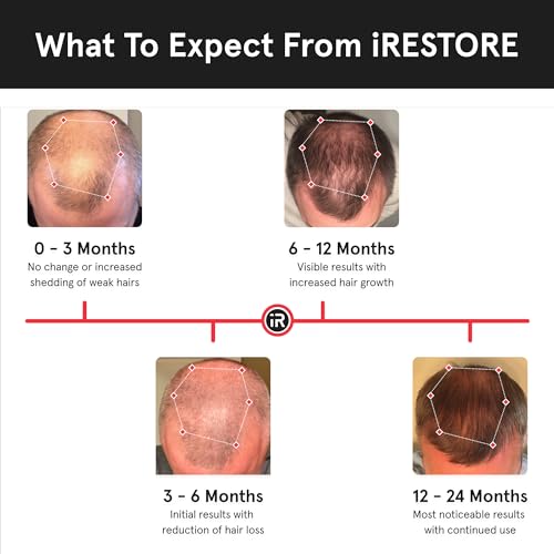 iRestore Laser Hair Growth System - FDA-Cleared Hair Loss Treatment & Treats Balding, Thinning Hair for Men and Women - Laser Hair Restoration Therapy Improves Hair Thickness, Volume, and Density by iRestore