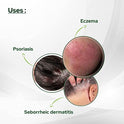 Psoriasis Coal Tar Salicylic Acid 100gm by SALVE