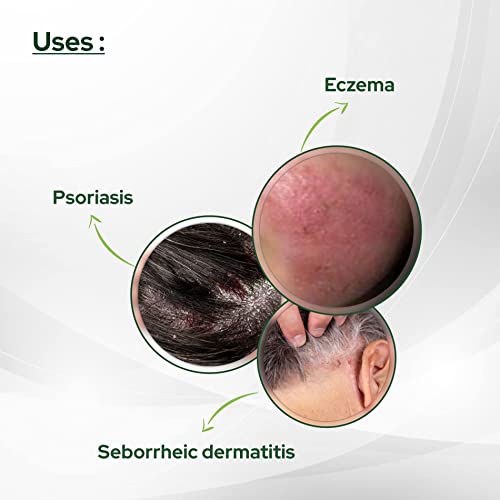Psoriasis Coal Tar Salicylic Acid 100gm by SALVE