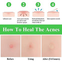 BREYLEE Acne Pimple Patch, Pimple Patch Acne Pimple Healing Patch Series