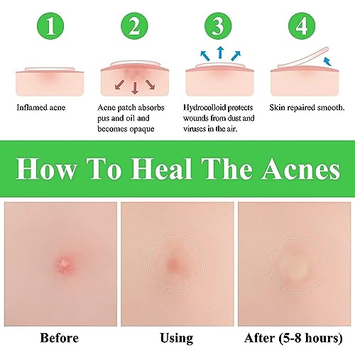 BREYLEE Acne Pimple Patch, Pimple Patch Acne Pimple Healing Patch Series