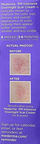 Mederma PM Crema intensiva para cicatrices durante la noche – Funciona con la actividad regenerativa nocturna de la piel – aplicación una noche se muestra clínicamente para hacer cicatrices más pequeñas y menos visibles
