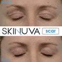 Skinuva - Crema para cicatrices de última generación, crema avanzada para eliminar cicatrices formulada con factores de crecimiento. (50,27 ml)