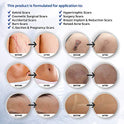 Puriderma Medical - Hojas de silicona para eliminar cicatrices (5 unidades) – Rápido y eficaz en queloides, cirugía, quemaduras, acné, cicatrices de sección C