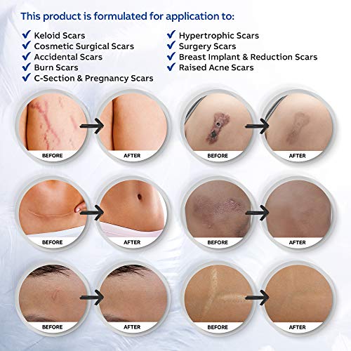Puriderma Medical - Hojas de silicona para eliminar cicatrices (5 unidades) – Rápido y eficaz en queloides, cirugía, quemaduras, acné, cicatrices de sección C