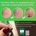 BREYLEE Acne Pimple Patch, Pimple Patch Acne Pimple Healing Patch Series