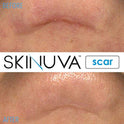 Skinuva - Crema para cicatrices de última generación, crema avanzada para eliminar cicatrices formulada con factores de crecimiento. (50,27 ml)