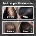 Champú para pérdida de cabello | Fórmula vegana DHT para adelgazar el cabello desarrollado por dermatólogos | Experimenta un cabello más saludable, más completo y más grueso – Shapiro MD