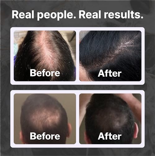 Champú para pérdida de cabello | Fórmula vegana DHT para adelgazar el cabello desarrollado por dermatólogos | Experimenta un cabello más saludable, más completo y más grueso – Shapiro MD