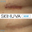 Skinuva - Crema para cicatrices de última generación, crema avanzada para eliminar cicatrices formulada con factores de crecimiento. (50,27 ml)